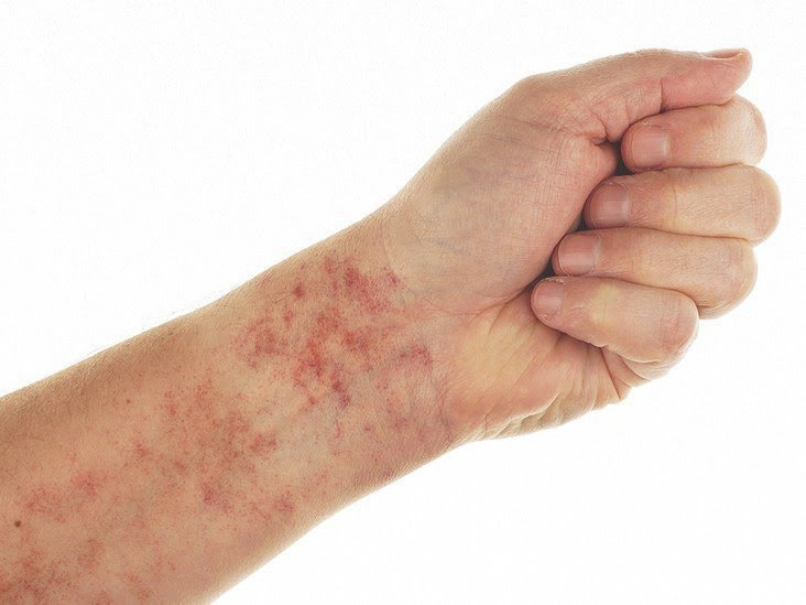 bệnh giảm tiểu cầu vô căn