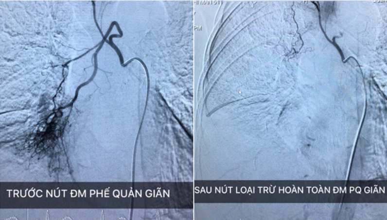 Nút động mạch phế quản