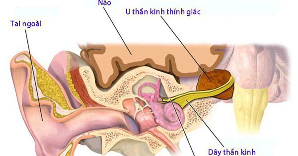 U dây thần kinh thính giác