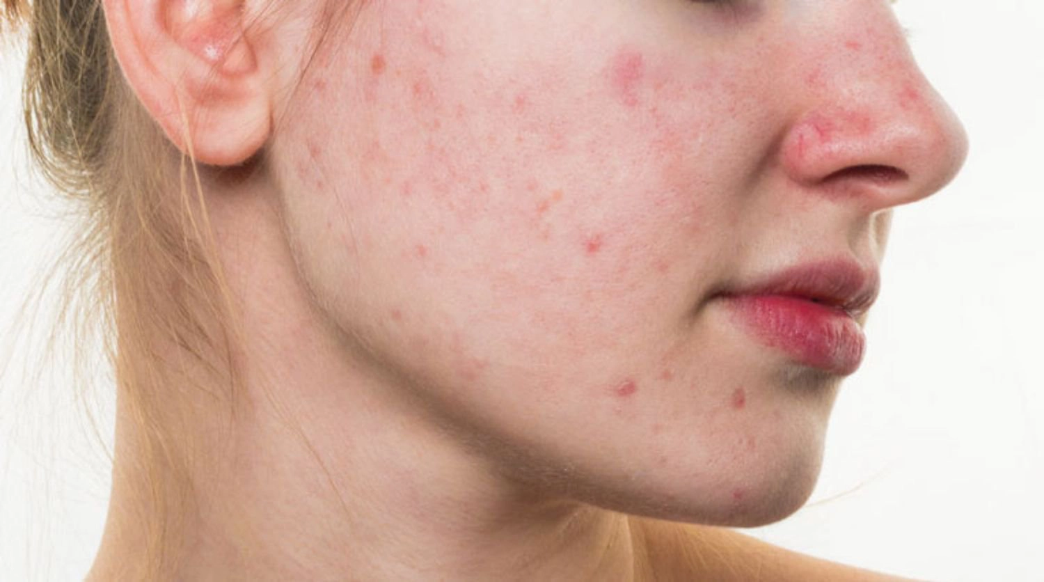 mụn trứng cá đỏ