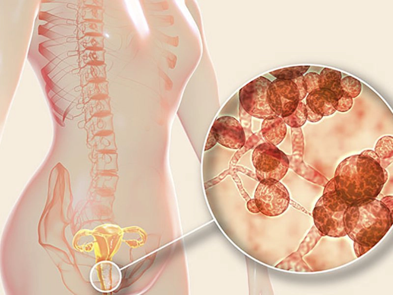 Nhiễm nấm candida