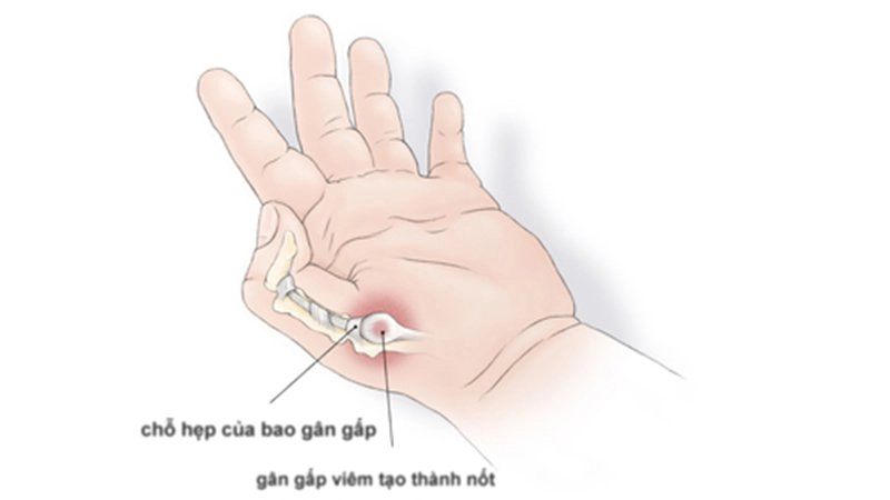 ngón tay cò súng