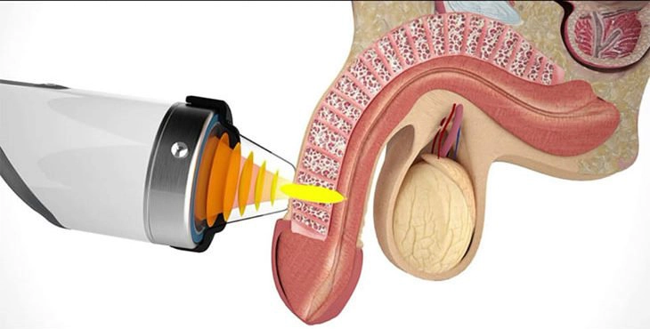 điều trị rối loạn cương dương bằng sóng xung kích