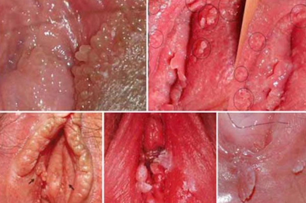 Sùi mào gà ở nữ