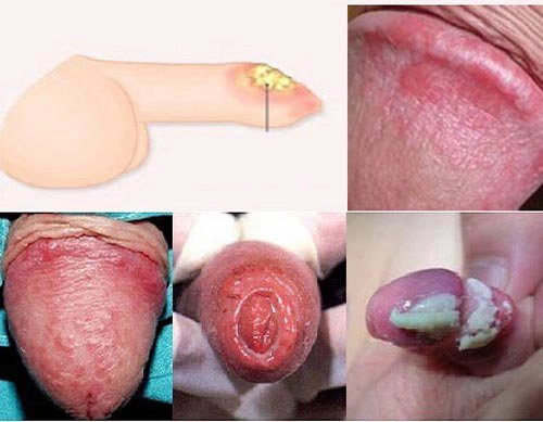 Viêm bao quy đầu mãn tính