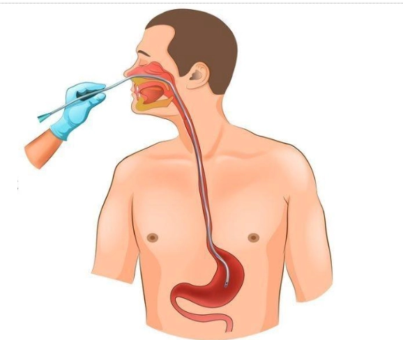 Dinh dưỡng qua ống tiêu hóa