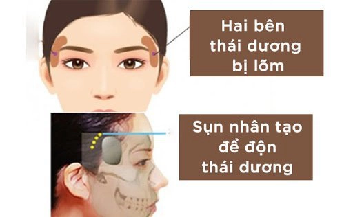 Độn thái dương