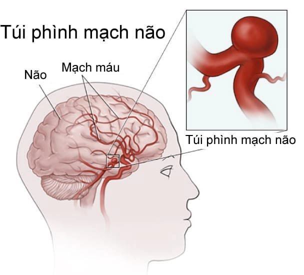 Túi phình mạch não