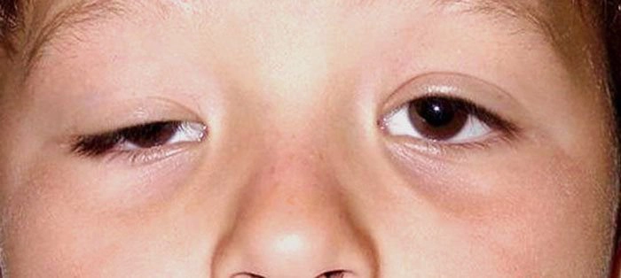 Bị sụp mí do bệnh nhược cơ có thể phẫu thuật kéo mí không?