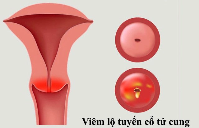 Viêm lộ tuyến