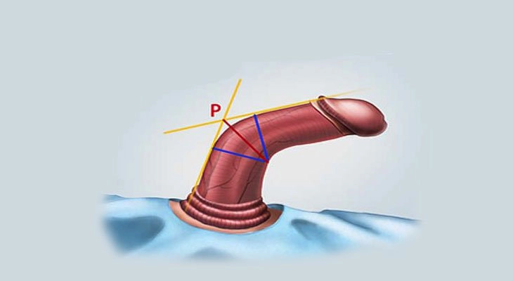 dương vật bị cong