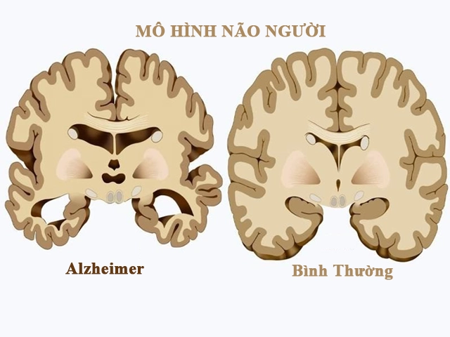 Nhận diện bệnh alzheimer qua biểu hiện cơ thể