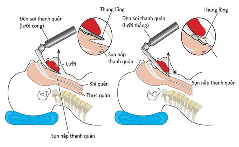 Quy trình gây mê nội khí quản