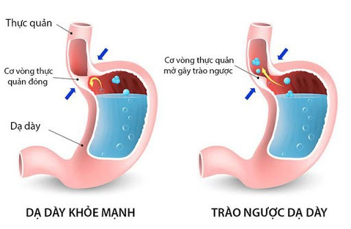 Trào ngược dịch dạ dày