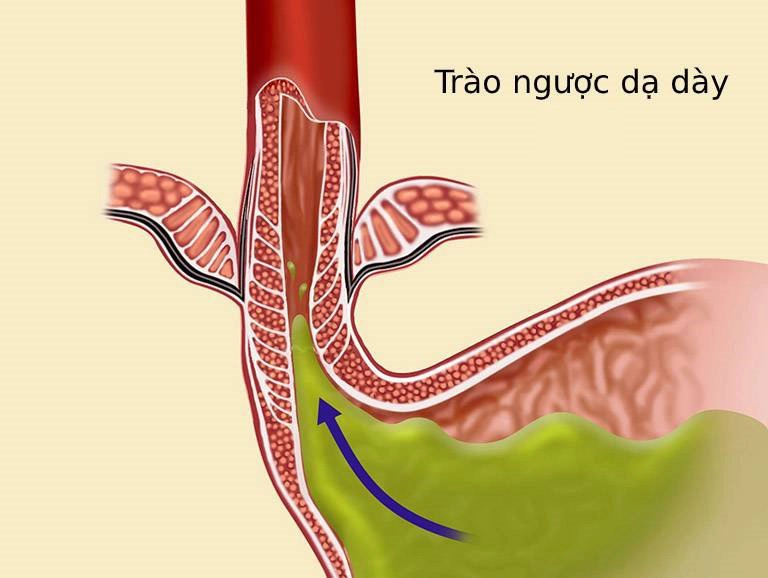 Trào ngược dạ dày