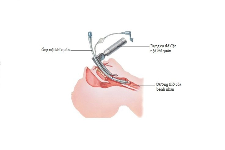 Đặt ống nội khí quản