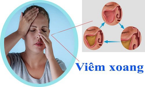 Nhiễm trùng ổ mắt là một biến chứng của viêm xoang