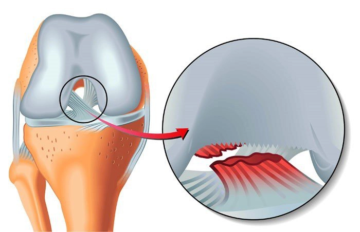 Đứt dây chằng chéo trước là một trong những chấn thương đầu gối thường gặp