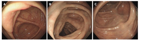 Các hình ảnh nội soi bệnh nhân có xơ vữa mạc treo tự phát. Hình A-C: Nội soi đại tràng trường hợp 3 cho thấy có sự đổi màu xanh nhạt ở đại tràng ngang