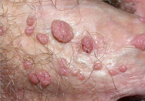 Bị nhiễm hpv có quan hệ được không khi xuất hiện mụn cóc snh dục