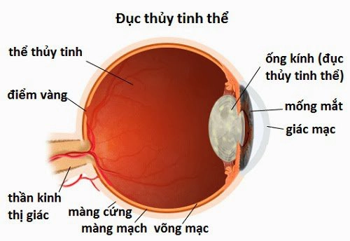 mo-phaco-1