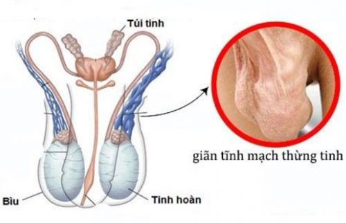 Giãn tĩnh mạch thừng tinh