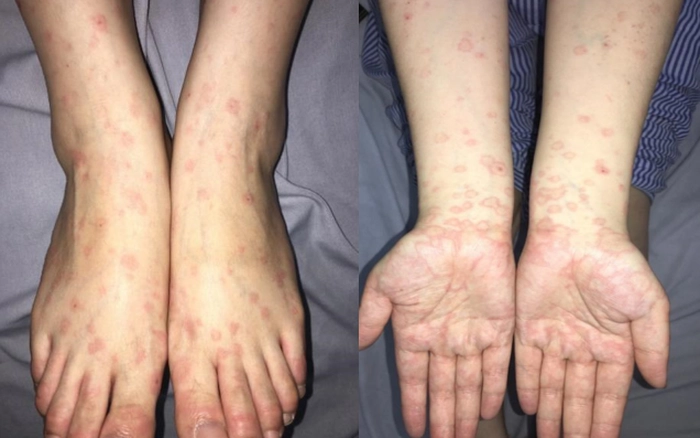 herpes sinh dục
