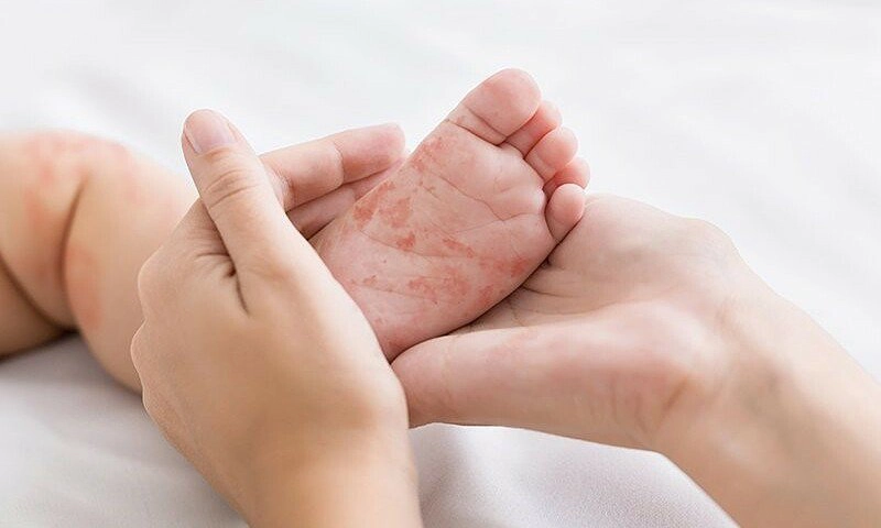 Biểu hiện và cơ chế của dị ứng đạm sữa bò ở trẻ