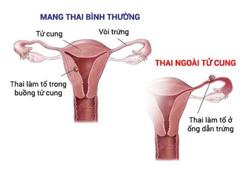 Mang thai ngoài tử cung gây chảy máu âm đạo