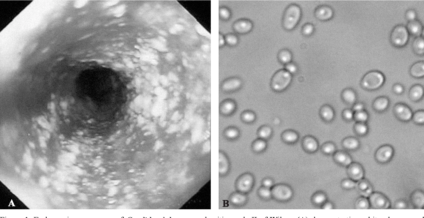 hinh-anh-nam-candida-soi-tuoi (3).png