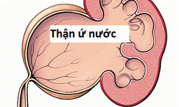 Thận ứ nước là bệnh gì?