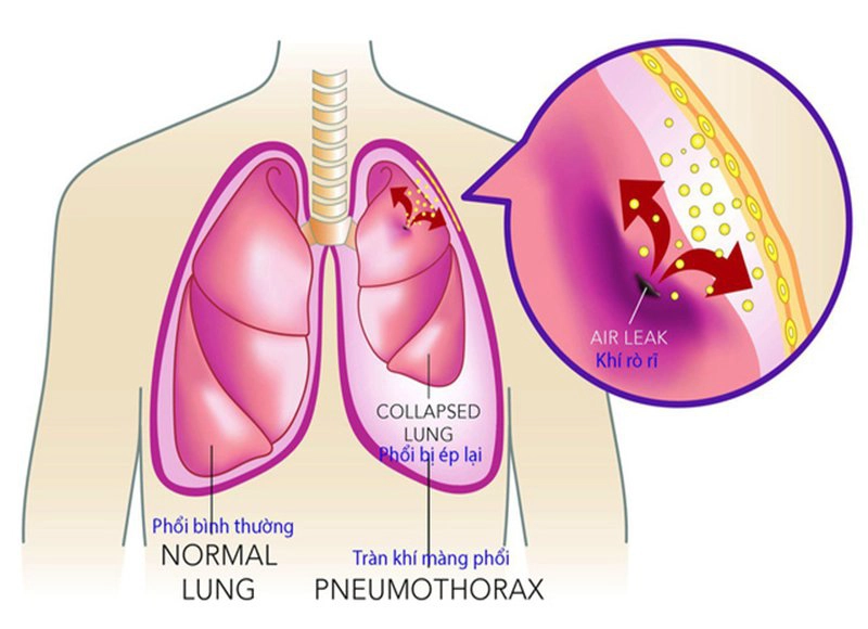 tràn khí màng phổi tự phát