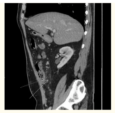 CT bụng và khung chậu có cản quang (nhìn sagittal) cho thấy sự thay đổi viêm đáng kể ở vùng hạ sườn phải ở mạc treo ruột bao quanh manh tràng (mũi tên trắng) và dày thành manh tràng (mũi tên chấm).