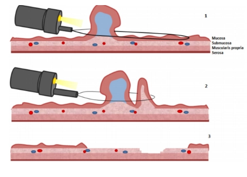 Lấy quá nhiều mô ở thành đại tràng khi cắt polyp có thể gây nên hội chứng sau cắt polyp