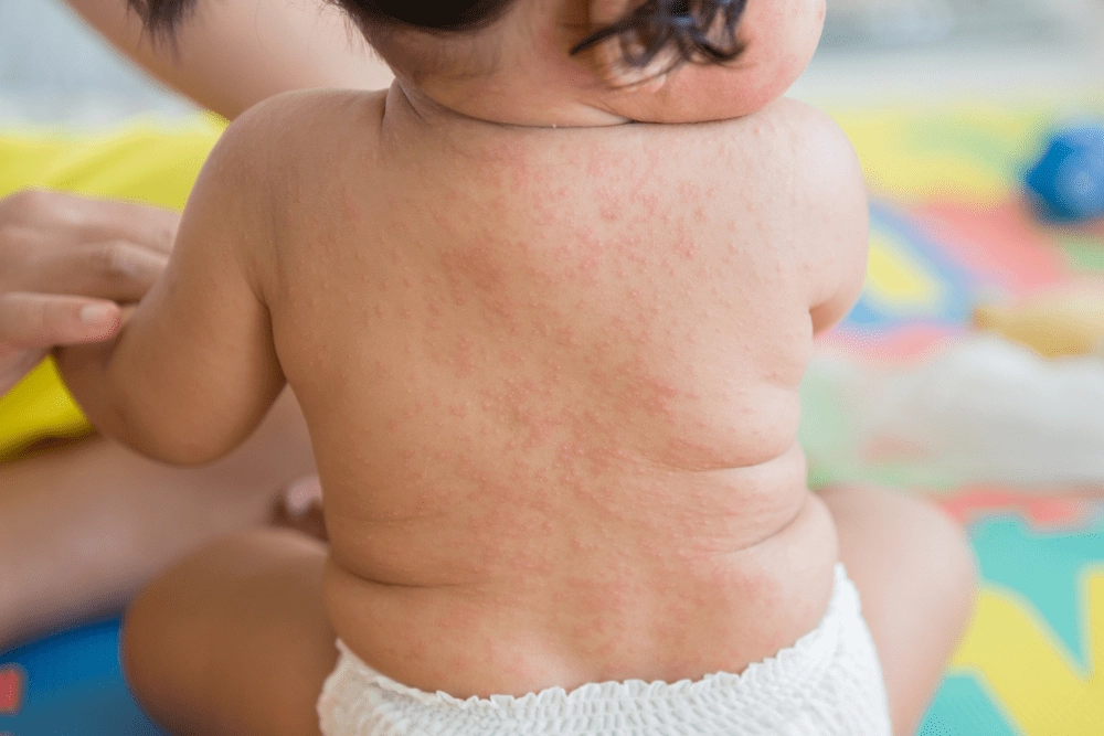 Bé bị sốt siêu vi phát ban phải làm sao