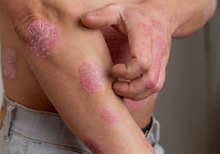 người bị vẩy nến
