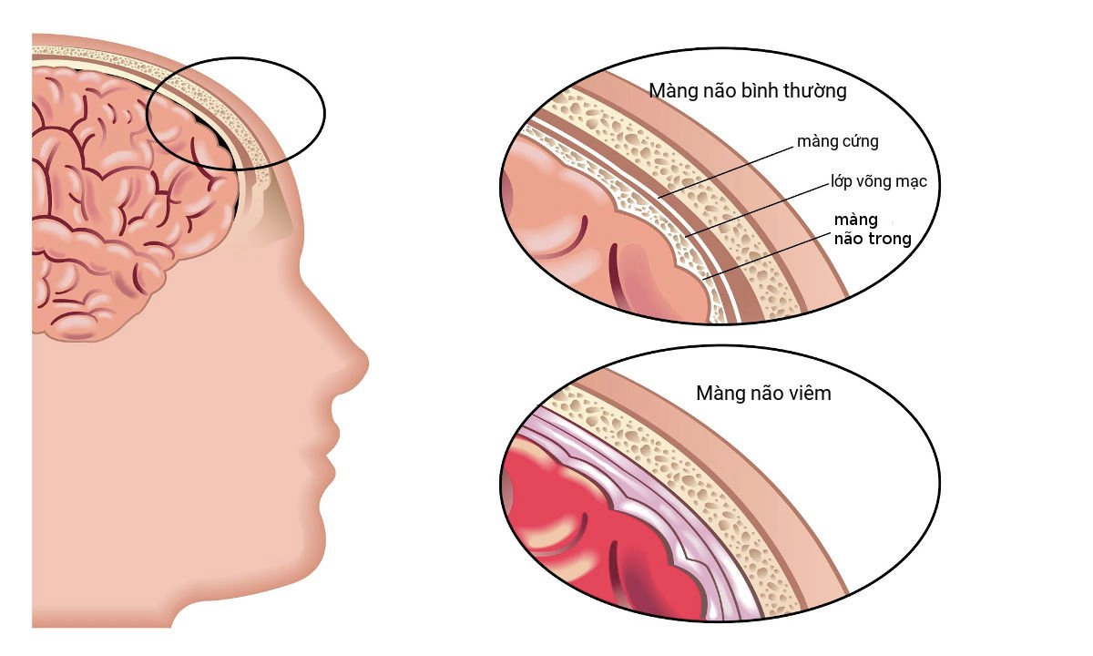 Viêm màng não là biến chứng nguy hiểm của bệnh tay chân miệng