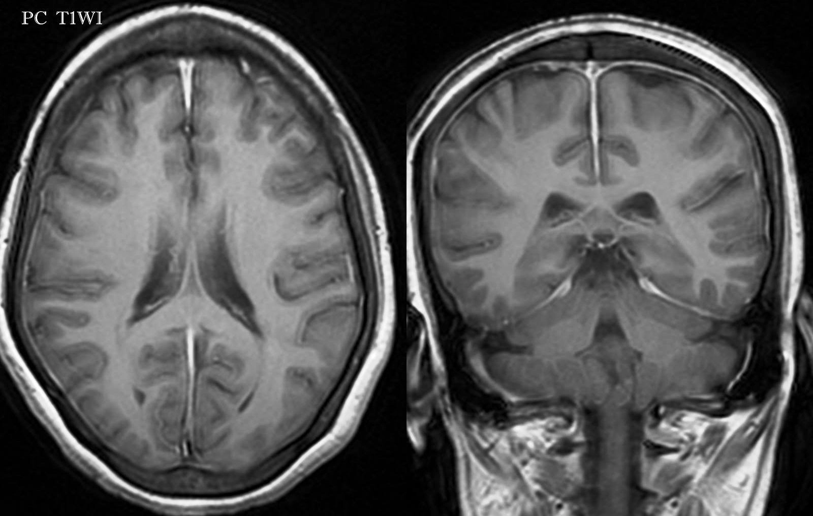 MRI bệnh viêm màng não