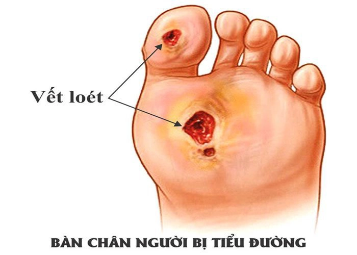 Nhiễm trùng ở bàn chân là một trong các biến chứng bàn chân tiểu đường