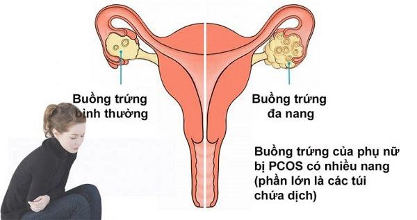 Hội chứng buồng trứng đa nang là nguyên nhân gây sảy thai