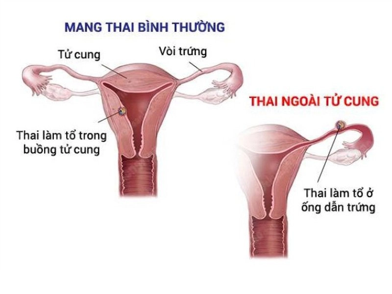 Siêu âm không có túi thai có phải mang thai ngoài tử cung không?