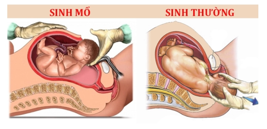 Không phải tất cả các trường hợp mang thai đều có thể sinh thường