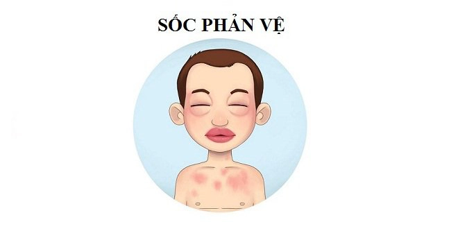 Dị ứng dưa hấu: Các triệu chứng và thực phẩm cần tránh