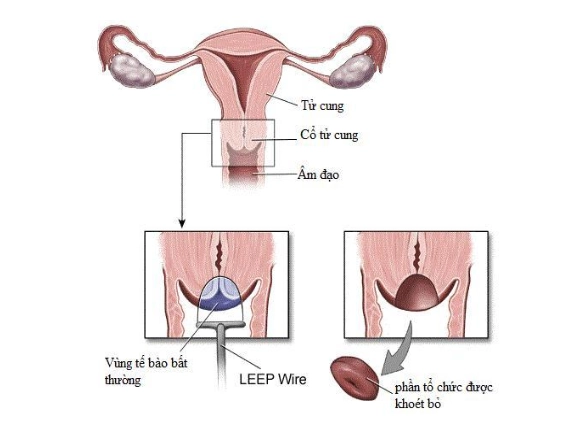 Thủ thuật khoét chóp cổ tử cung bằng vòng điện (LEEP)