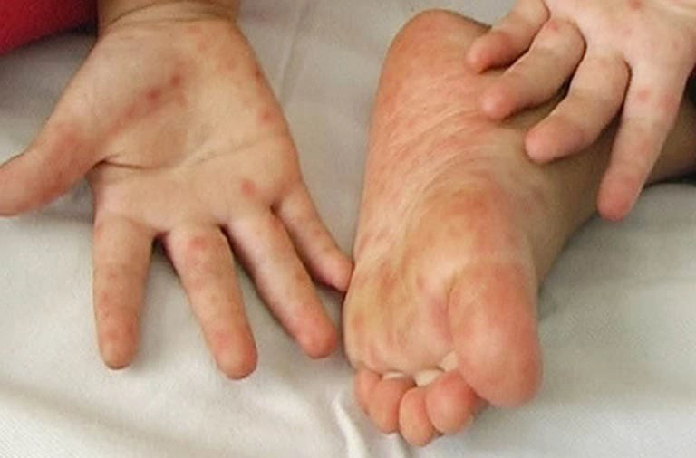 nổi mụn nước ở lòng bàn tay