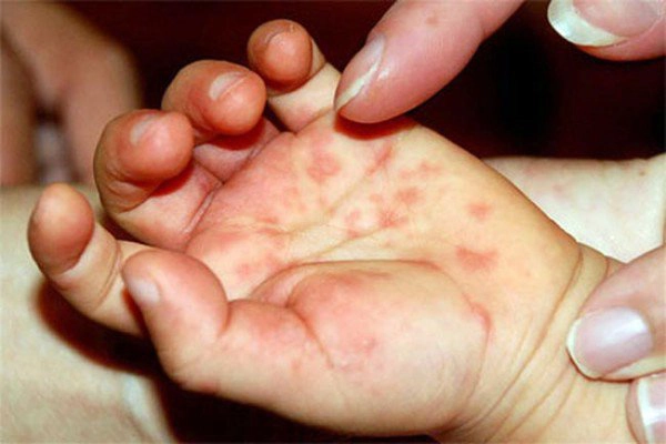 nổi mụn nước ở lòng bàn tay