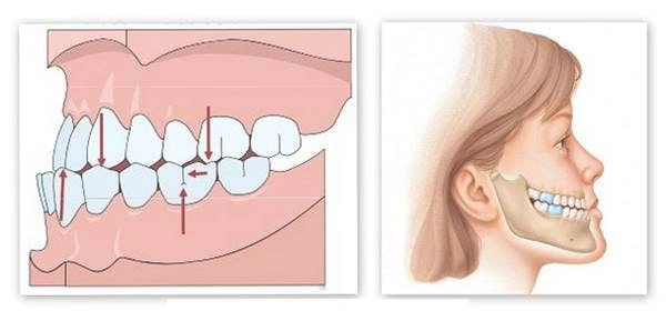 Trường hợp trẻ hay nghiến răng có thể do khớp cắn bị lệch