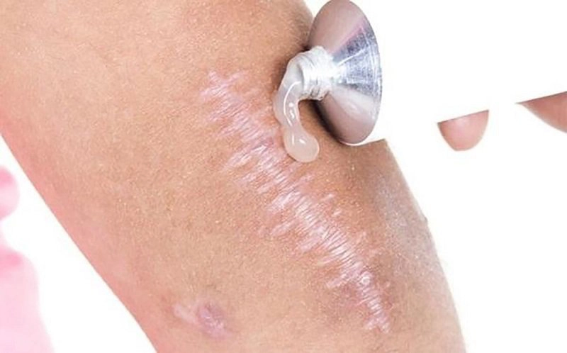 Bôi thuốc giúp làm mềm và phẳng sẹo, giảm ngứa và đau nhức khi vết sẹo bị sưng