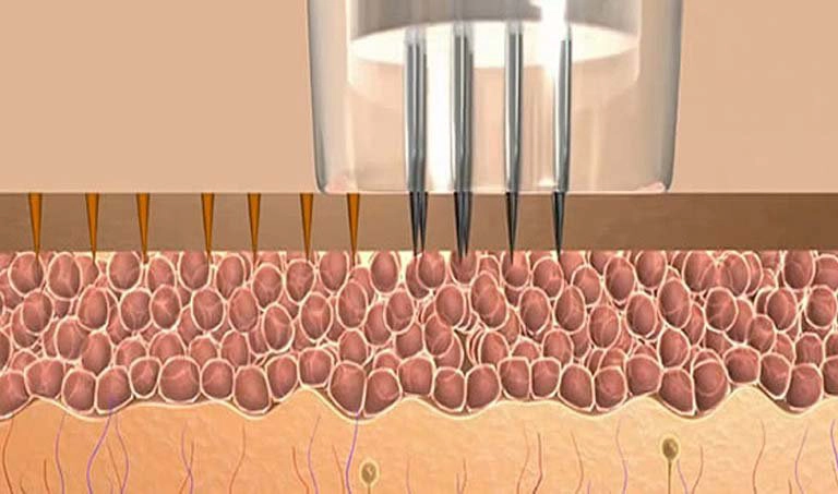 Lăn kim có trị được rạn da không là thắc mắc của nhiều chị em