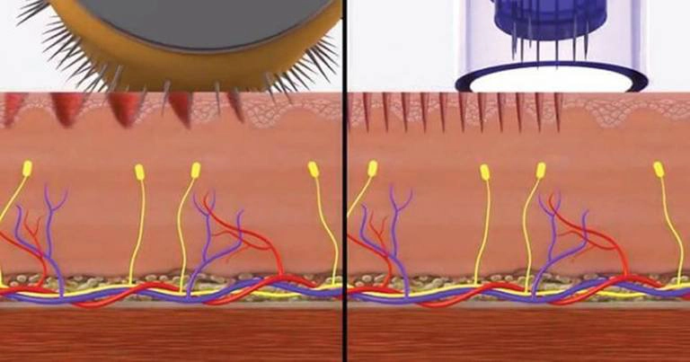 Lăn kim trị rạn da do khả năng tái tạo làn da bị rạn nứt của công nghệ này